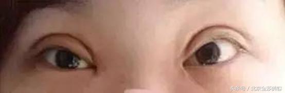 做出来的双眼皮和天然双眼皮区别,怎么样做的双眼皮才是最成功的