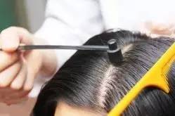 中医药治疗脱发的中药方,中医药治疗脱发效果