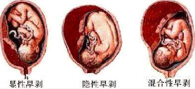 孕妇什么情况下容易发生胎盘早剥,胎盘早剥多少可致胎儿死亡