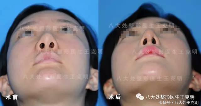 鼻整形后出现肿胀、假体外露歪斜、皮肤异样该怎么办?