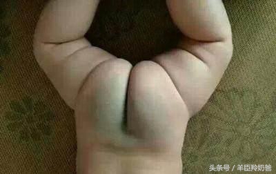 宝宝一出生脸上有一块褐色的胎记,婴儿有青色胎记是怎么回事