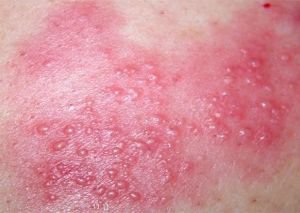 带状疱疹影响视力咋办,鼻子上长带状疱疹咋办