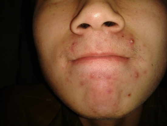 消了又长的疮是什么疮,脸部长疮的症状和治疗方法