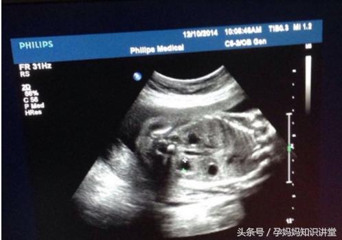孕四个月的b超图怎么看,怎么看b超单判断胎儿怀孕