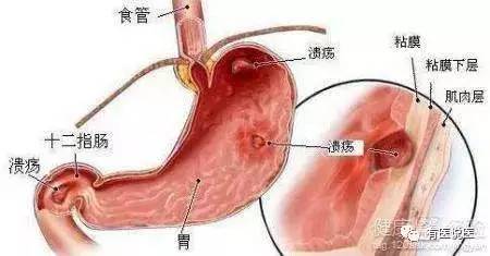 十二指肠穿孔和吃得太多有关系吗,80多岁十二指肠穿孔