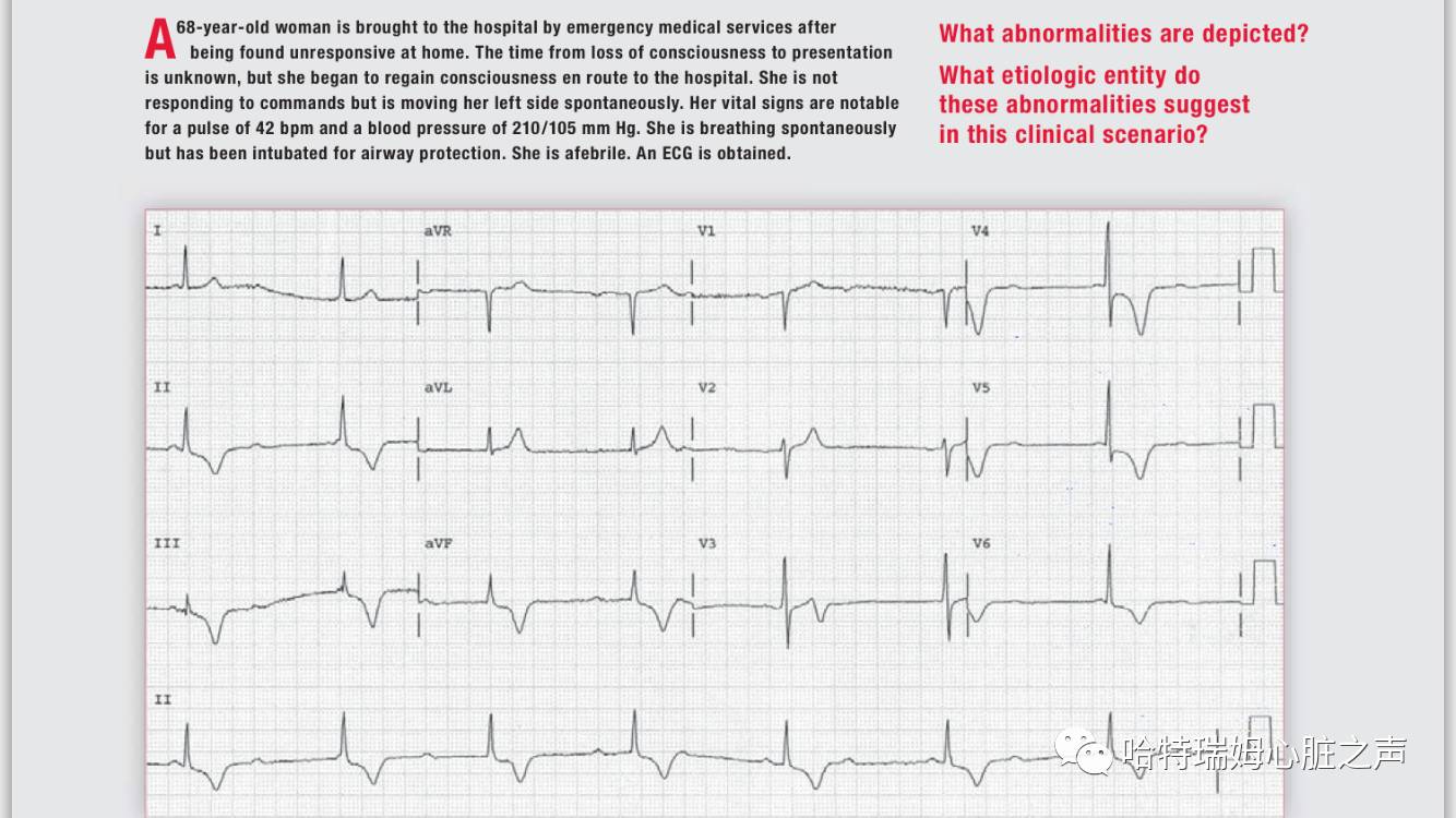 「读心有术」057期：这么多的T波倒置，该怎样诊断？