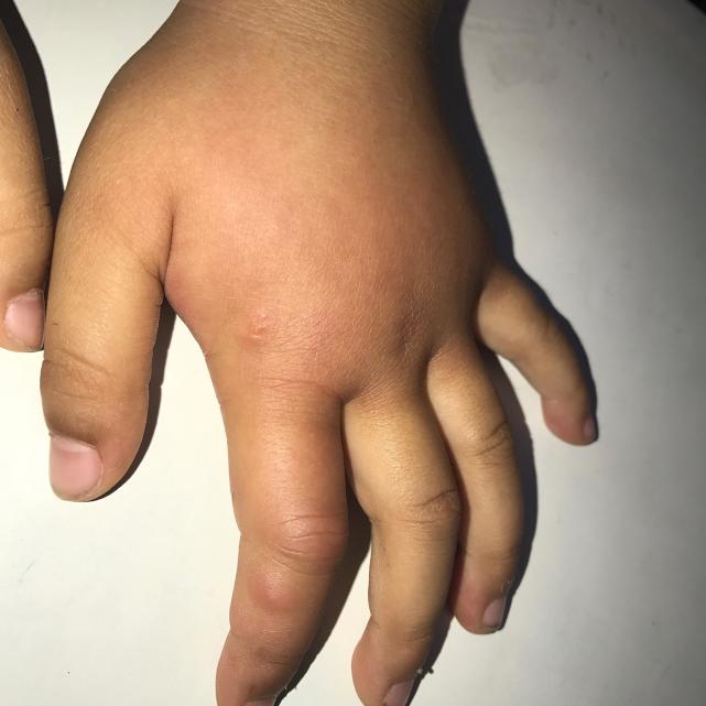 孩子小手被蚊子咬了后肿了,宝宝手被蚊子咬了个大包怎么办