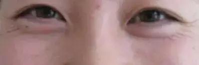 抢救假性眼纹、眼袋的黄金时间，错过你就老了