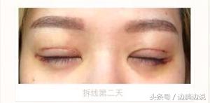 外科医生申霄,申霄医生双眼皮风格