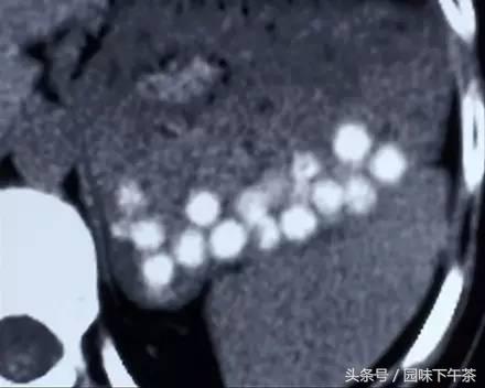 珍珠奶茶里的“珍珠”可致肠梗阻?珍珠究竟是啥?