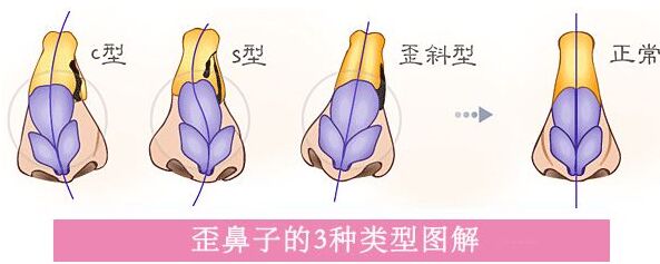 歪鼻子怎么办,歪鼻子有什么办法呢