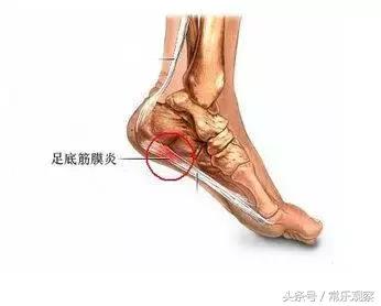 足底筋膜炎创新型康复,足底筋膜炎的康复治疗方法是什么