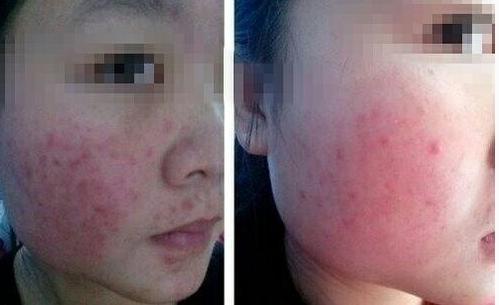 什么是激素脸痘痘,什么是激素痘