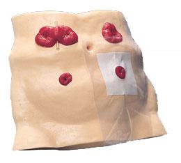 什么是人造肛门?为什么有的能还纳有的要带终身