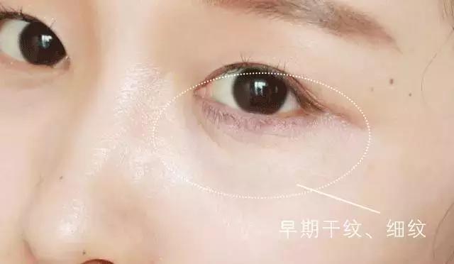 抢救假性眼纹、眼袋的黄金时间，错过你就老了