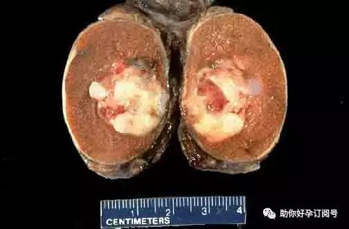 畸胎瘤八大超声征象,畸胎瘤肿瘤五项