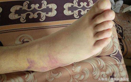 如何缓解跑步导致的踝关节扭伤,跑步扭伤脚腕怎么治疗