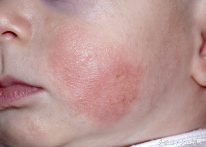 宝宝脸上长像扁平疣的疙瘩,宝宝脸上长小颗粒是丝状疣吗