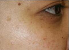 祛斑好的方法目前最有效的,祛斑好的办法