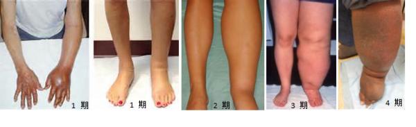 妇科肿瘤术后肢体淋巴水肿的预防