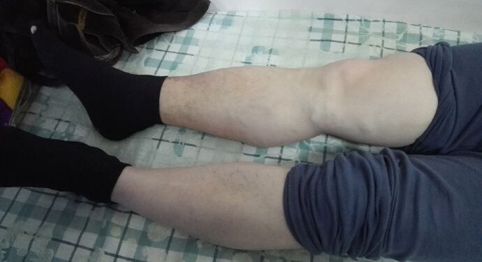 涓嬭偄闈欒剦鏇插紶濡備綍閿荤偧,涓嬭偄闈欒剦鏇插紶涓尰杈ㄨ瘉璁烘不