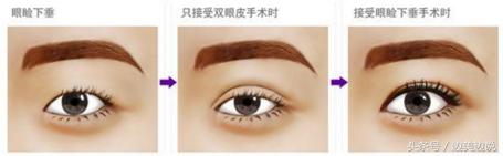 大小眼如何改善,青少年大小眼怎么改善