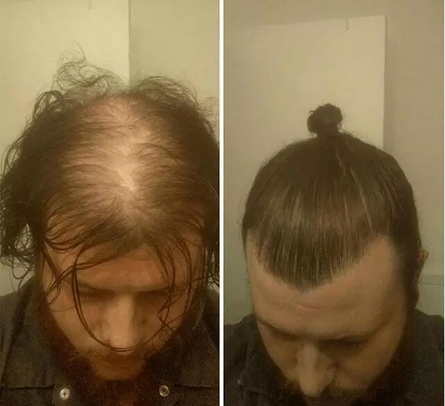 彻底摆脱脱发现在有什么技术,如何治愈脱发重新生发