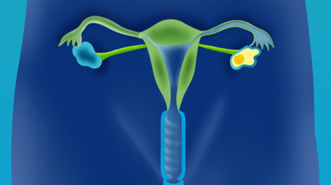 卵巢癌的6个征兆自测,卵巢癌怎么判断早期还是晚期