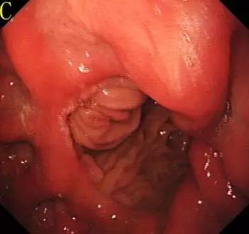 胃镜预处理流程,胃镜内镜手术全流程