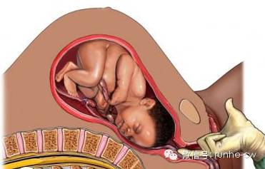 胎儿命悬一线医生托举24分钟救命,孕26周胎儿抢救