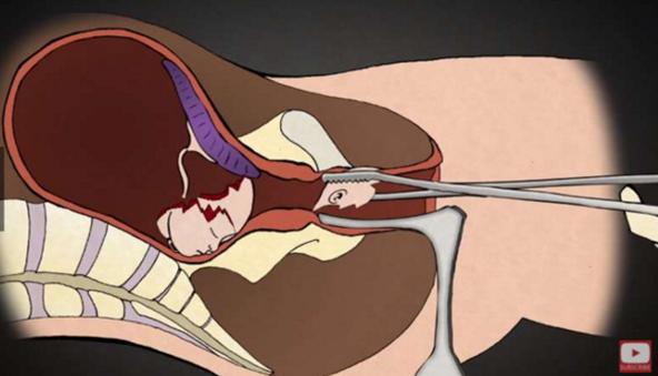 堕胎手术详细流程,女性堕胎手术的可怕真相