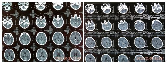 航空总医院病例,航空总医院脑修复科