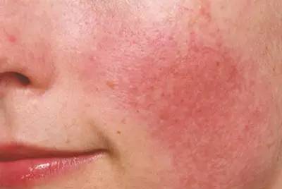 基础护肤的正确步骤油性皮肤,基础护肤的正确的全部步骤