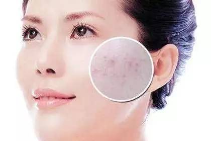 什么医美项目快速有效祛痘印,积雪苷霜软膏祛痘印多久有效