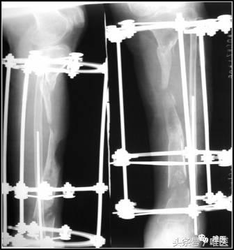 胫骨平台骨缺损处理,胫骨下端部分骨缺损如何植骨