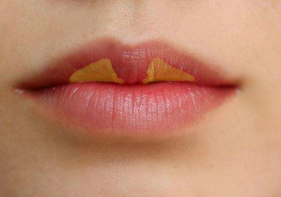 很多人嘴唇上有一道疤,为什么上嘴唇会多出一点肉