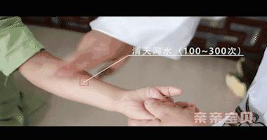 小儿湿疹推拿手法解析,小儿湿疹推拿方法