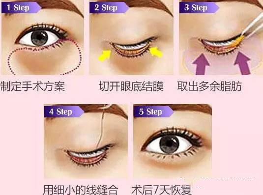 卧蚕眼袋黑眼圈傻傻分不清楚,卧蚕和眼袋的区别图片对比