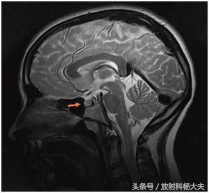 男子性腺功能减退治疗,男子脑内有多个肿瘤