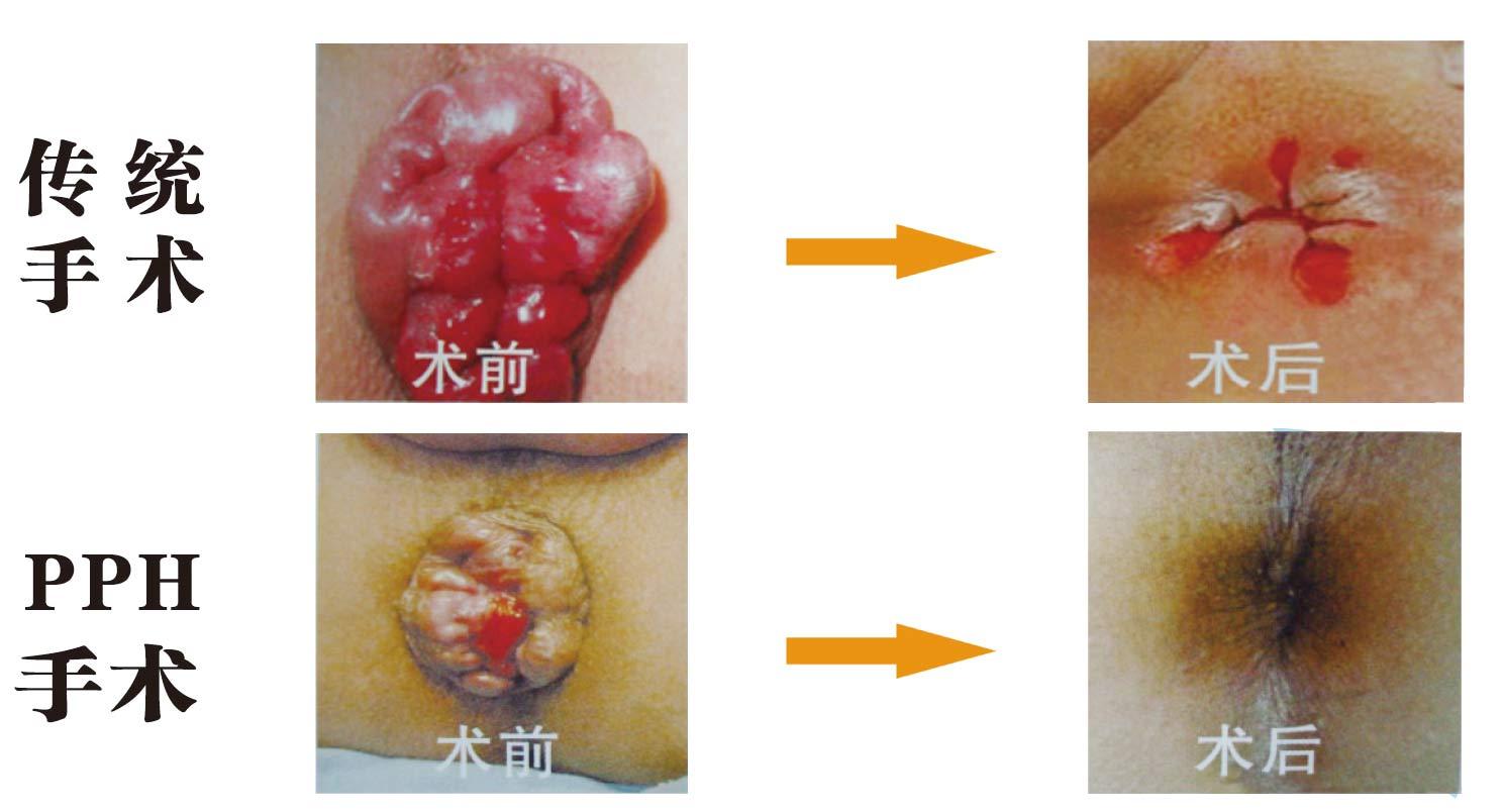 痔疮患者需要知道的必要事项,真正快速治好痔疮的方法