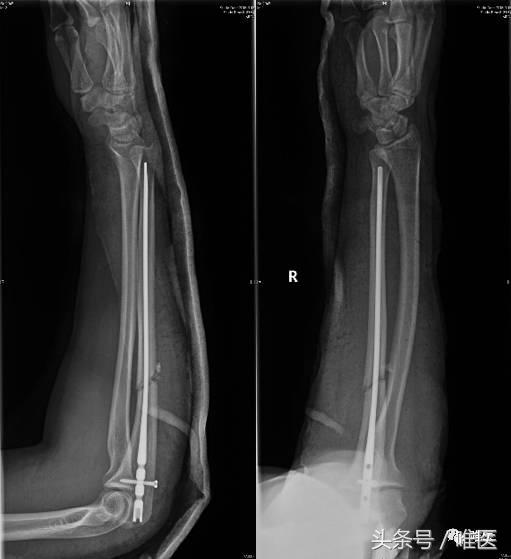 肱骨髓内钉的手术体位,肱骨髓内钉术后康复恢复步骤