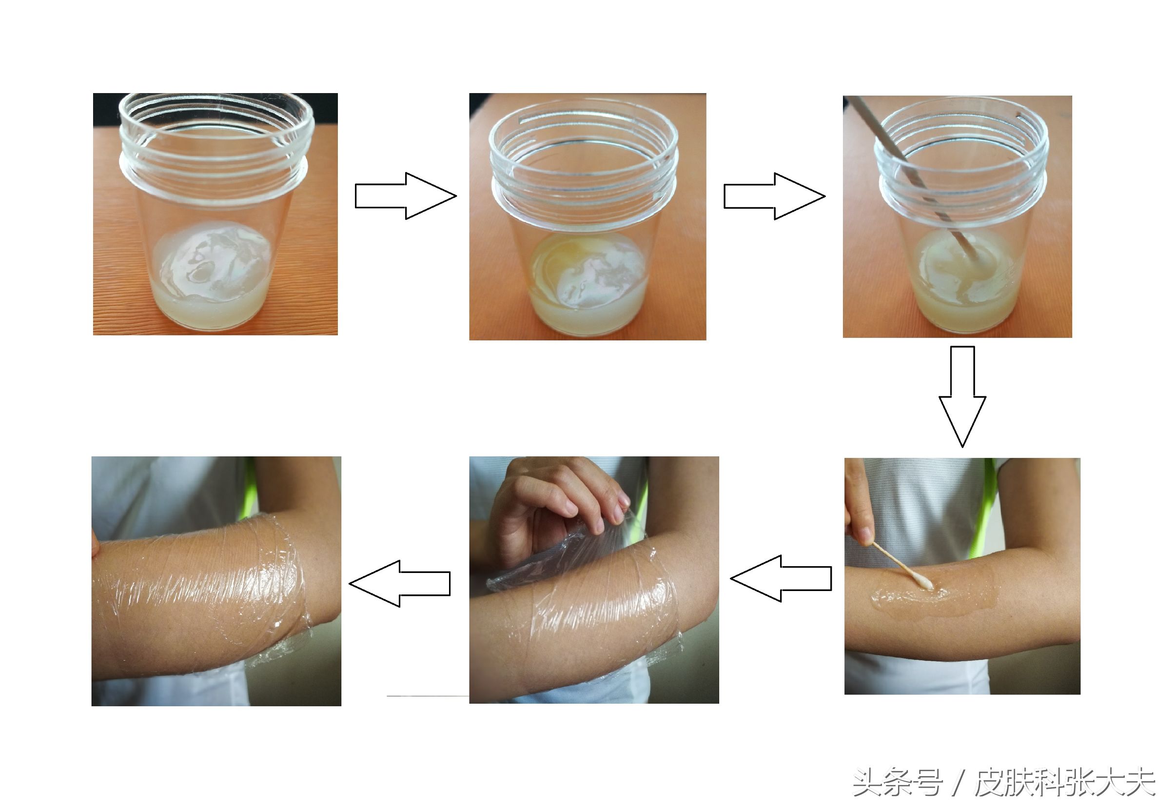 牛皮癣如何防止加重,牛得牛皮癣怎么治疗能彻底根除
