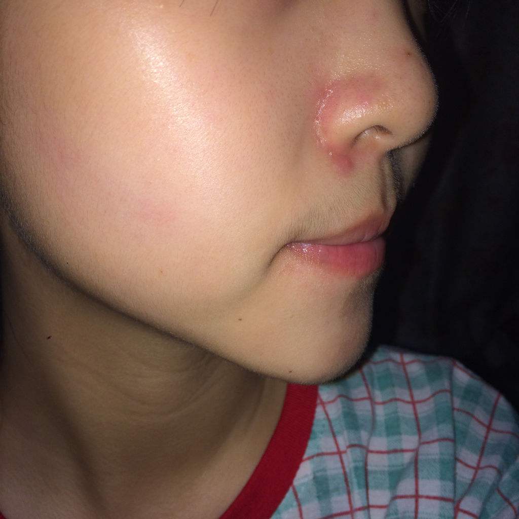 鼻翼红血丝怎么遮,鼻翼两侧红血丝可以挑破吗