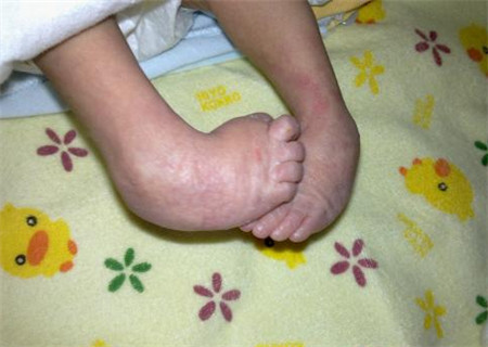 四维双足内翻宝宝能不能要,四维查出胎儿足内翻后期会长好吗