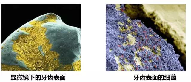 龋齿属于虫牙吗,蛀牙龋齿虫牙是怎么形成的