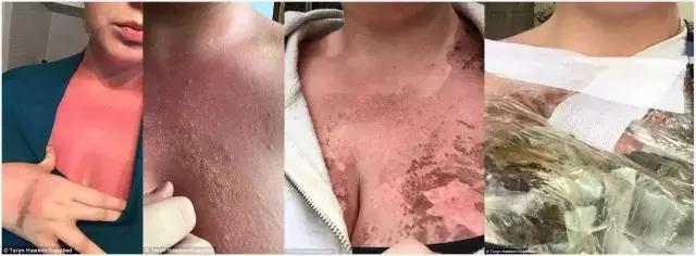 儿童涂防晒霜之前需要涂防晒霜吗,香蕉船防晒霜晒伤事件