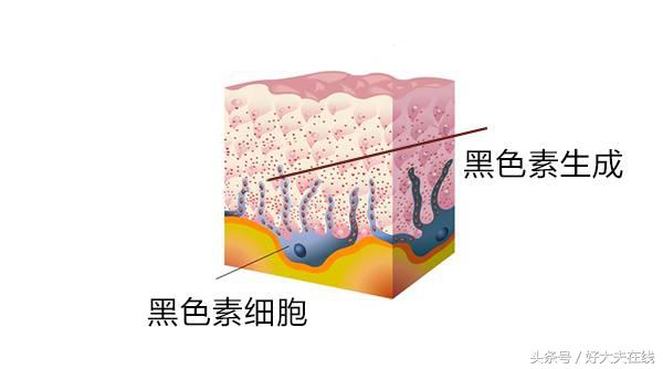 痣短期变大一定是恶化吗,医生能否判断痣是否正常