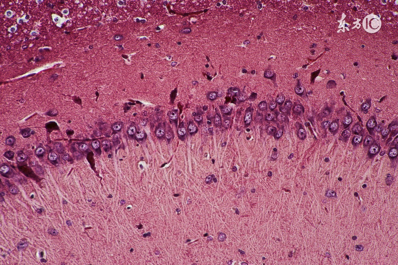 过敏性紫癜复发了怎么办,过敏性紫癜复发了怎么处理