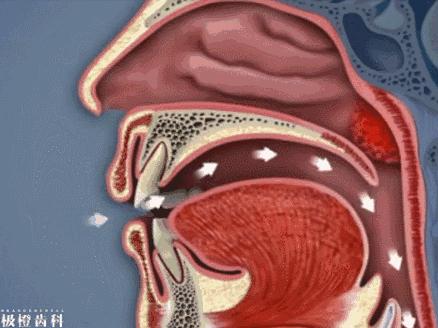 用嘴呼吸的对容貌的影响,用嘴呼吸会导致什么面容