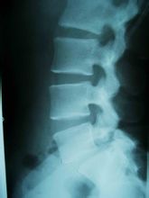 腰椎骨质增生怎么治疗最好得快,中医正骨能治骨质增生吗